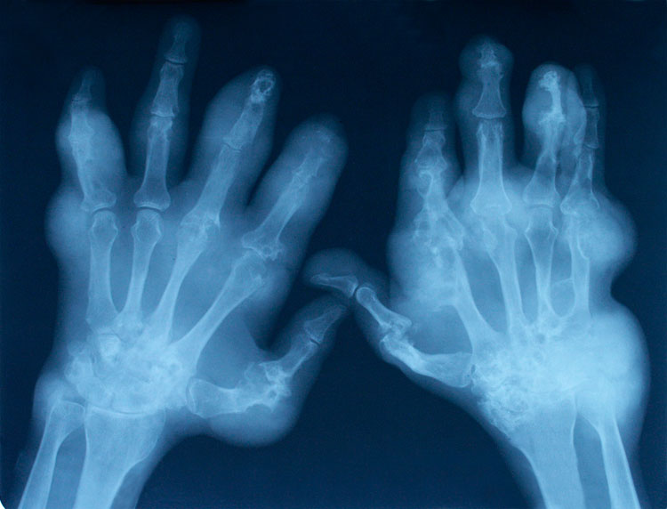cum să vindecăm artrita de mână
