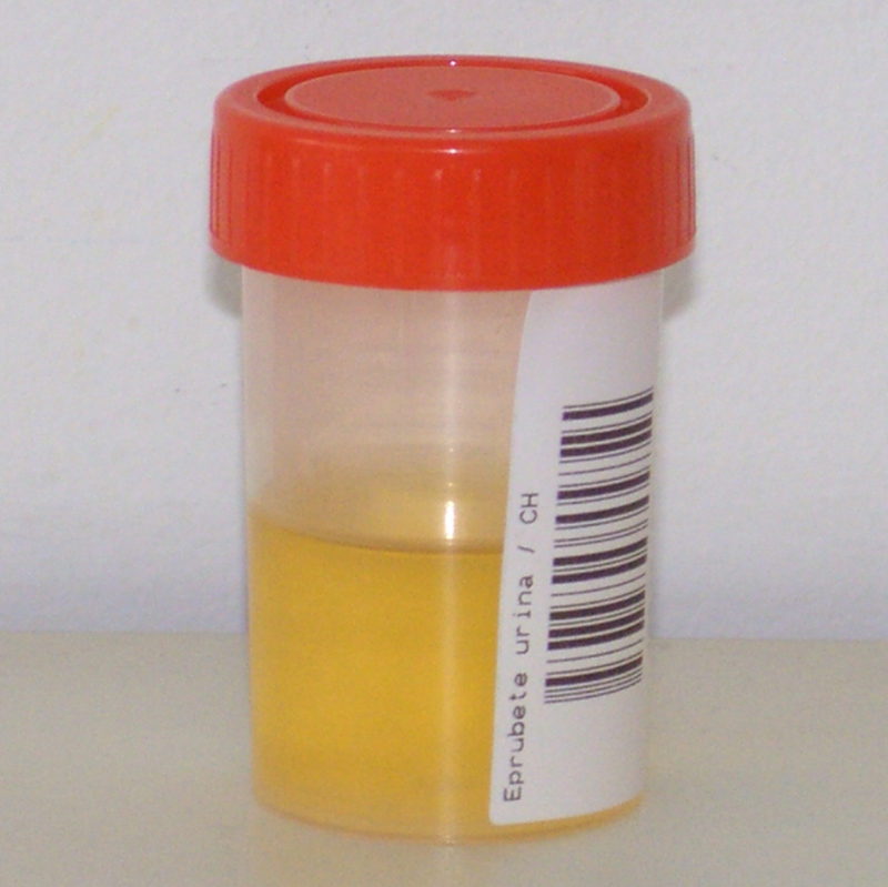 urină galbenă cu prostatită