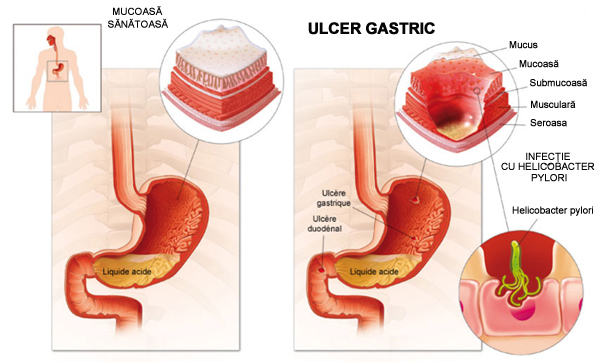 Câteva sfaturi și remedii naturiste pentru ulcerul gastric si ulcerul duodenal