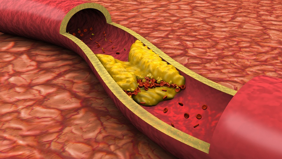 Metode naturale eficiente de scadere a nivelului de colesterol