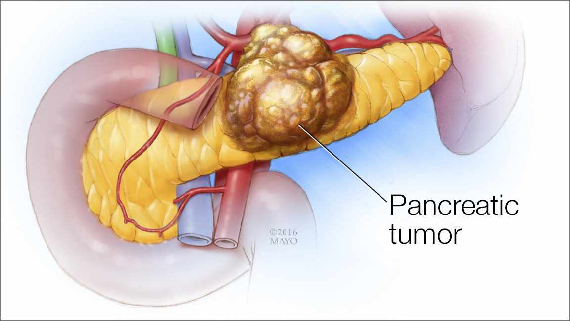 Ce trebuie să ştii despre cancerul de pancreas: Simptome, factori de risc, tratament